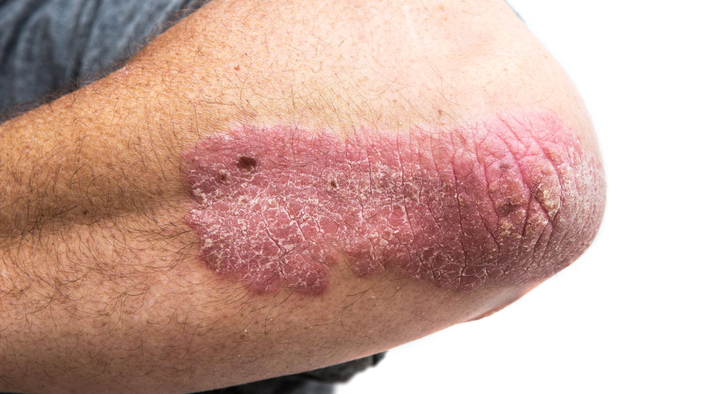 Für Psoriasis vulgaris (Plaque-Psoriasis, Schuppenflechte) charakteristischer, leicht erhabener, geröteter, mit Schuppen bedeckter Plaque.